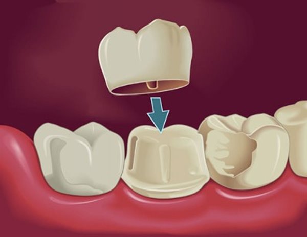 Dental crown