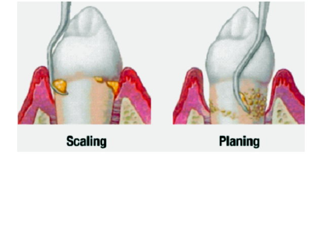 Deep Gum Cleaning