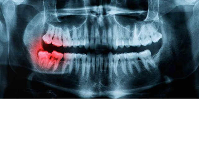 Wisdom teeth Extraction